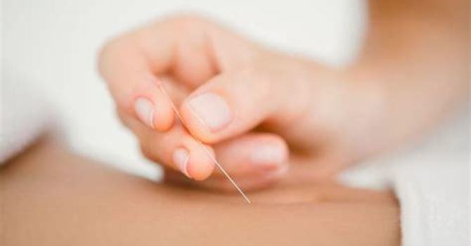Acupuncture